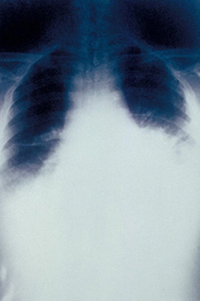 PA Röntgenaufnahme: Lungenmilzbrand - verbreitertes Mediastinum